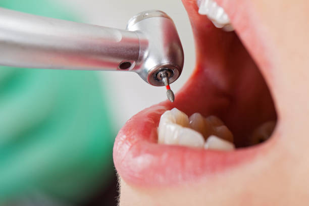 Best Emergency Tooth Extraction in Chantilly, VA